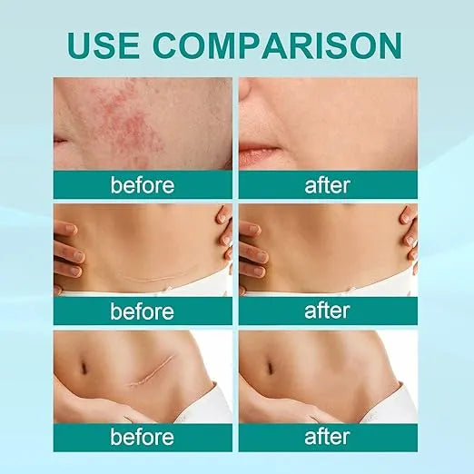 🔥South Moon Medical Grade Scar Spray | Scar Care Spray for Acne, Surgery, Burns & Stretch Marks (20g) Zambeel