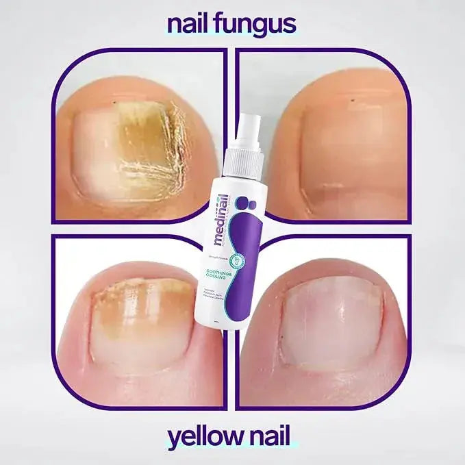 🔥Jaysuing Nail Fungus Spray 100ml | Nail Repair & Healthy Nail Care Spray