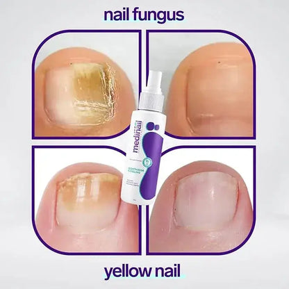 🔥Jaysuing Nail Fungus Spray 100ml | Nail Repair & Healthy Nail Care Spray